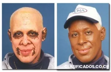 Tratamiento para el vitíligo o leucoderma